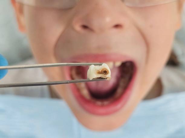Best Knocked-Out Tooth (Avulsed Tooth) Treatment in Quinnesec, MI
